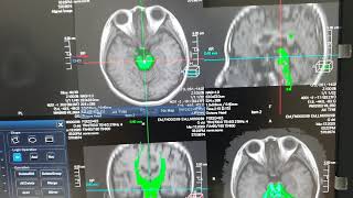 DTI Tractography mri [upl. by Ahsan650]