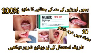 Daktarin oral gel how to usefor mouth fungel infectioncomplete reviewDaktarin gel for babies [upl. by Tullus]