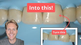 How I Fixed Chipped Front Teeth Full Restoration Process Explained [upl. by Rothschild]