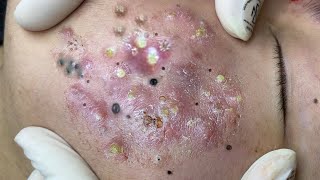 Big Cystic Acne Blackheads Extraction Blackheads amp Milia Whiteheads Removal Pimple Popping  65473 [upl. by Mahda]