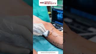 Can Varicose Veins Return After Treatment [upl. by Neeham334]