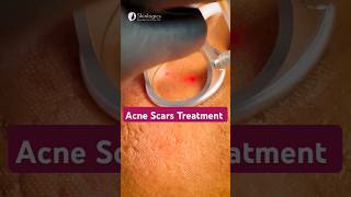 How to get rid of acne scars  Acne scars treatment acne acnescarsremoval [upl. by Yarb]