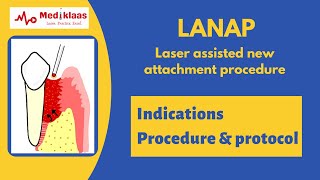 LANAP Laser assisted New Attachment procedure l Periodontal Regeneration l Mediklaas [upl. by Nirtak]