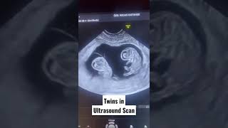 Twins pregnancy on ultrasoundDiamniotic monochorionic twin pregnancy shortvideo like subscribe [upl. by Raouf]