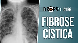 ALTERAÇÕES TÍPICAS DE FIBROSE CÍSTICA NO RX E NA TC [upl. by Otina]