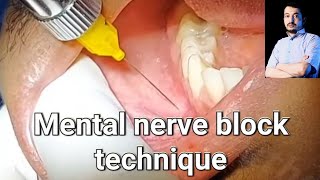 Local Anesthesia Mental Nerve block technique mandibular anesthesia Techniques dentistry [upl. by Jakoba]