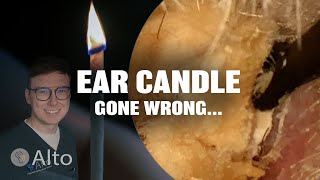 This Ear Candle Makes Hearing WORSE  Ear Wax Removal [upl. by Juliann]