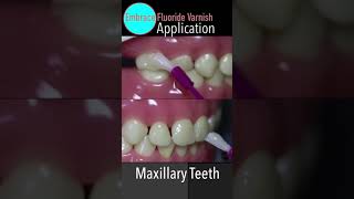 Embrace Fluoride Varnish Application🟣Pulpdent🟡 shorts [upl. by Nohs]