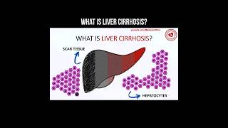 What is liver cirrhosis liver cirrhosis livercirrhosis hepatology [upl. by Reilamag906]