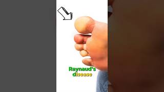 Do you have Raynauds The Dos and Donts [upl. by Orelle]