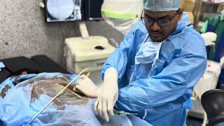 PCN PERCUTANEOUS NEPHROSTOMY STEP BY STEP UNEDITED PROCEDURE VIDEO [upl. by Orlantha]