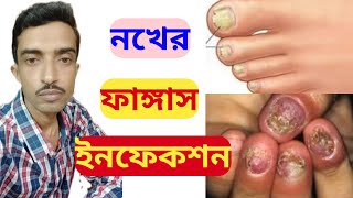 Nail Fungus Infection Treatment In Bengali  Homeopathic Medicines For Nail Fungus  Bangla [upl. by Aceissej699]