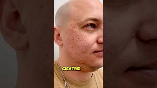 Peeling de Ácido Tricloroacético em cicatriz de acne peelingquimico peelingtca acidoata shorts [upl. by Lleon3]