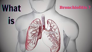 Chronic Bronchitis The Hidden Breathing Struggle Millions Face Every Day  Modern Medicine [upl. by Einafpets876]