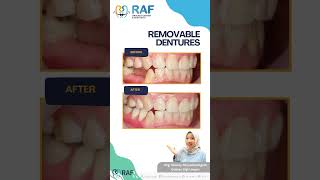 Removable dentures valplast gigitiruan dentist [upl. by Adihsar296]