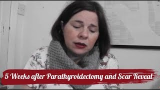 5 Weeks after Parathyroidectomy and Scar Reveal [upl. by Sioled719]