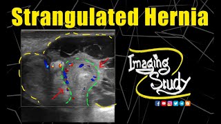 Strangulated Umbilical Hernia with Abscess Formation  Ultrasound  Doppler  Case 199 [upl. by Elyse888]