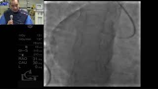 A case of heavily calcified LAD ostial and RCA stenosis Mirror Image Dextrocardia [upl. by Waterman152]