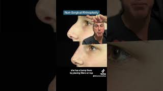 NonSurgical Rhinoplasty [upl. by Nalrah942]