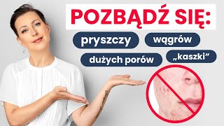 PRYSZCZE WĄGRY ŚWIECENIE  przyczyny i skuteczne metody na pozbycie się ich [upl. by Ellives]