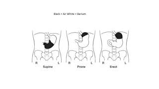 Radiographic Positioning of the Stomach [upl. by Belcher]