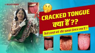 Cracked tongue क्या हैं कैसे इससे बचें और इसका ईलाज क्या है [upl. by Santini]