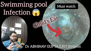 Microsuction Magic Clearing Swimmers Ear Infection in a Child [upl. by Elberfeld]