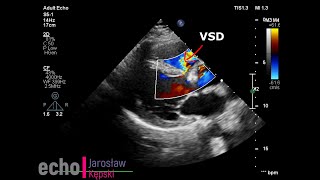 Ventricular Septal Defect VSD echocardiography echo congenital heart disease [upl. by Auqkinahs73]