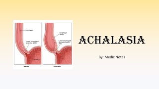 Achalasia  clinical features investigation manometry findings medical and surgical treatment [upl. by Mehs]