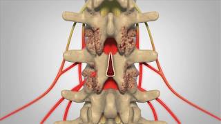 Laminectomy  Patient Education [upl. by Chute]