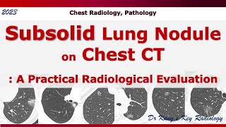 Subsolid lung nodule on CT A Radiological evaluation [upl. by Haidabo]