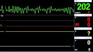 Ventricular Fibrillation  VFib [upl. by Asa]