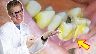 Patients Tooth FALLS OUT During Deep Cleaning TONS OF PLAQUE TARTAR amp GROSS Bacteria Removed [upl. by Riedel]