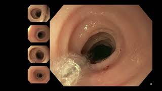 Eosinophilic Oesophagitis Stricture Dilatation [upl. by Sher]