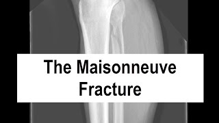 The Maisonneuve Fracture [upl. by Barra]