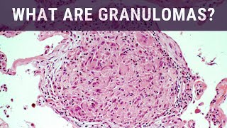 What are Granulomas  Pathology mini tutorial [upl. by Umeh]