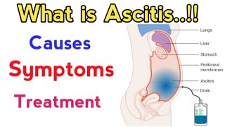 causes of ascites fluid in abdomen  treatment of ascites due to liver cirrhosis  ascites fluid [upl. by Holle]