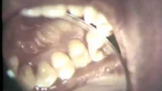 Periodontal Examination Part II Charting [upl. by Llevert]