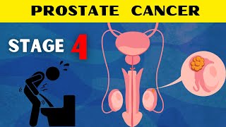 Prostate Cancer Stage 4 Treatment and Side Effects [upl. by Letha313]