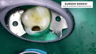 large Carious lesion in the tooth [upl. by Weslee]