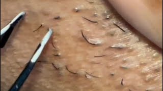 INGROWN HAIR REMOVAL 37  2022 a little suprise pluck 😷 [upl. by Ellimahs721]