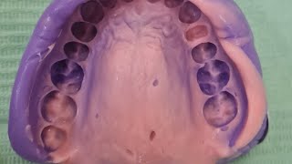 Addition Silicone Impression Wax tryin amp Insertion of Zirconia Crowns مقاس الاسنان بالعربي [upl. by Annaira977]