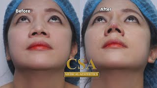 Non Surgical alar reduction in minutes [upl. by Akeinahs]