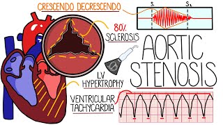 Aortic Stenosis Explained in 10 Minutes With Heart Murmur Sound [upl. by Shuman814]