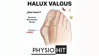 EJERCICIOS PARA EL JUANETE O HALUX VALGUS FISIOTERAPIA Y REHABILITACION [upl. by Sutphin133]