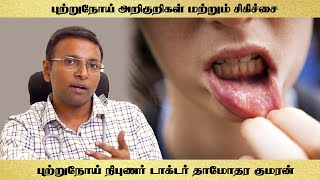 Mouth cancer Symptoms and treatment Dr Damodara kumaran [upl. by Onailil]