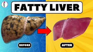 Strictly Avoid these 5 Foods if you have Fatty Liver  Fatty liver treatment  liver disease [upl. by Salkin]