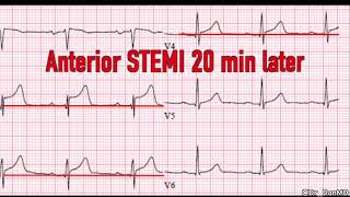 hyper acute t waves STEMI [upl. by Nirraj69]