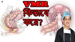 Simplified video of VMR for rectal prolapse [upl. by Xilef905]