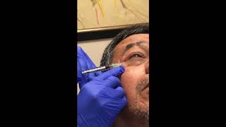 Botox for Facial Spasms [upl. by Mulloy291]